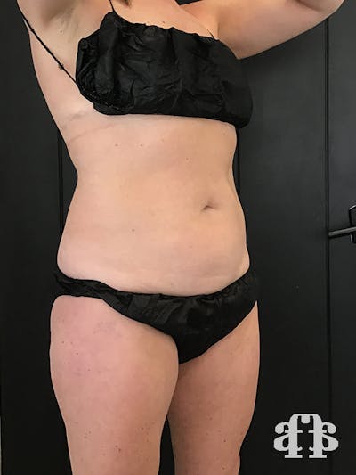 CoolSculpting Before & After Gallery - Patient 52660126 - Image 1