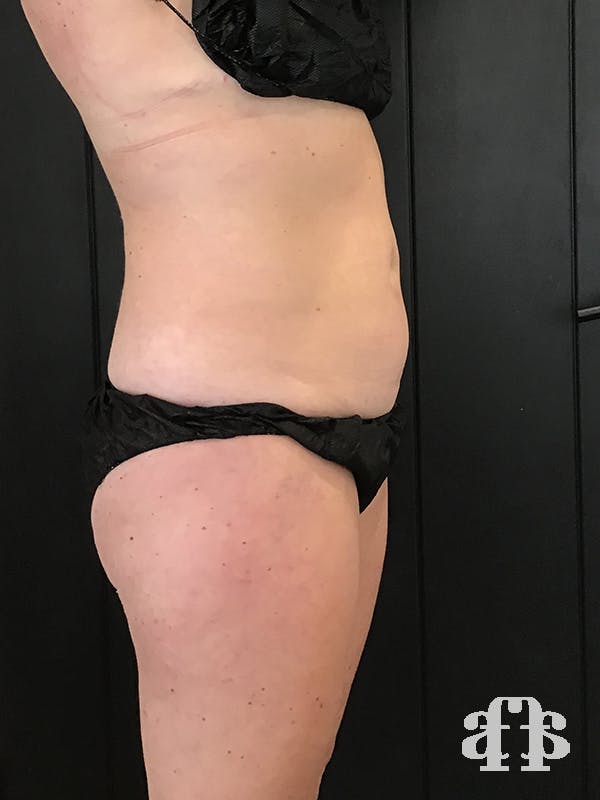 CoolSculpting Gallery - Patient 52660126 - Image 3