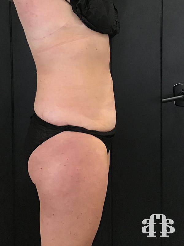 CoolSculpting Gallery - Patient 52660126 - Image 4