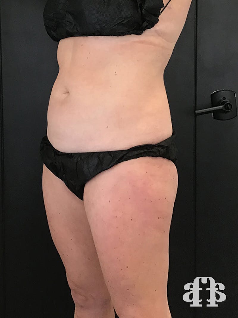 CoolSculpting Before & After Gallery - Patient 52660126 - Image 5