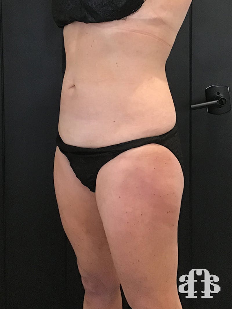 CoolSculpting Before & After Gallery - Patient 52660126 - Image 6