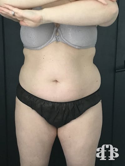 CoolSculpting Before & After Gallery - Patient 52660135 - Image 1