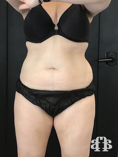CoolSculpting Before & After Gallery - Patient 52660135 - Image 2