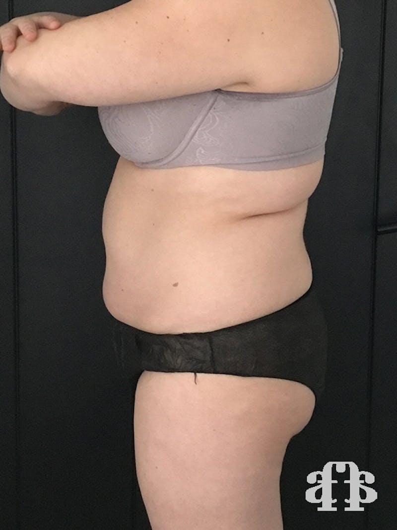 CoolSculpting Before & After Gallery - Patient 52660135 - Image 3