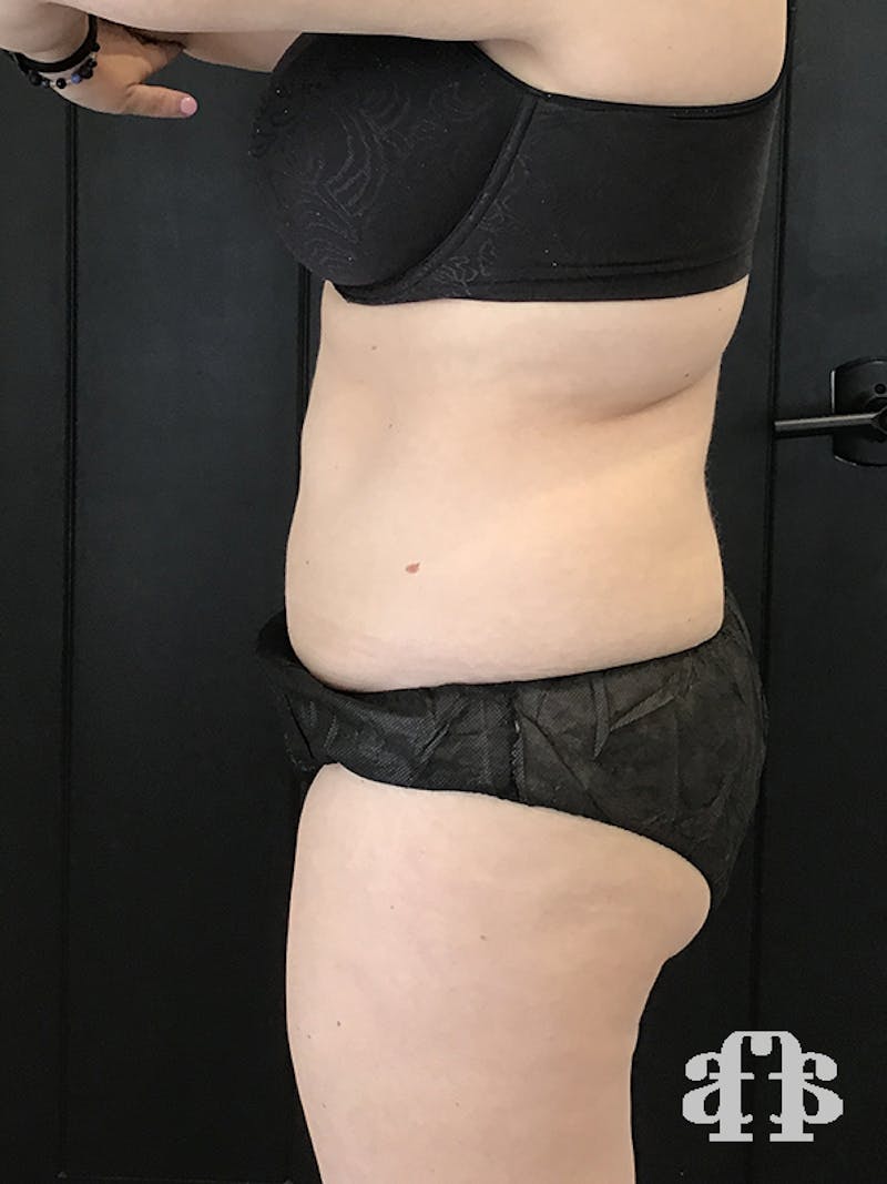 CoolSculpting Before & After Gallery - Patient 52660135 - Image 4