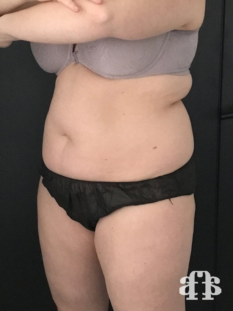 CoolSculpting Before & After Gallery - Patient 52660135 - Image 5