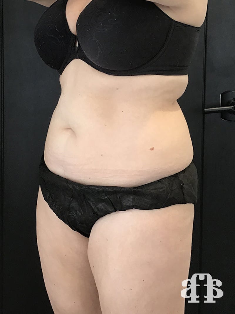 CoolSculpting Before & After Gallery - Patient 52660135 - Image 6