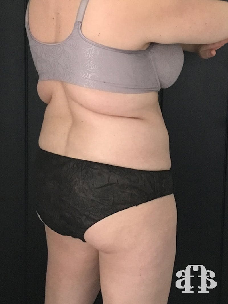 CoolSculpting Before & After Gallery - Patient 52660135 - Image 7