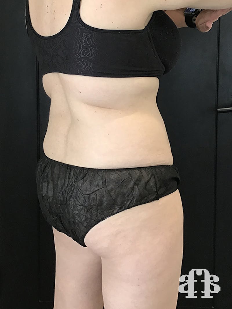 CoolSculpting Before & After Gallery - Patient 52660135 - Image 8