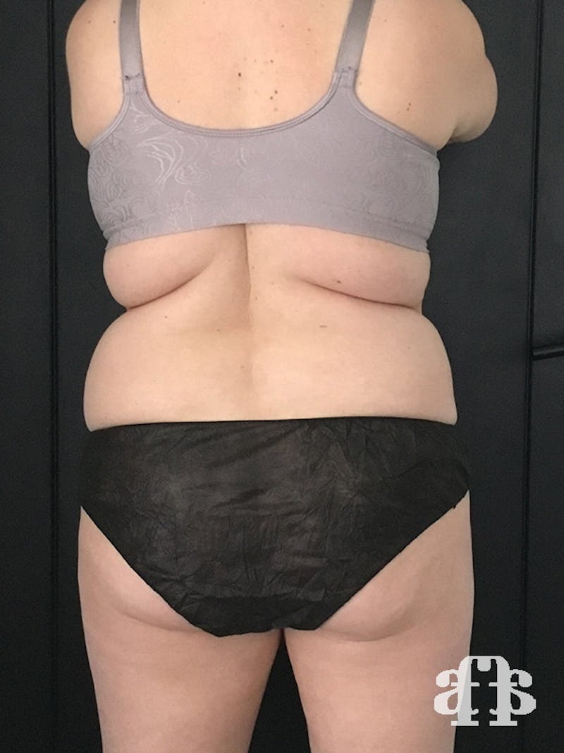 CoolSculpting Before & After Gallery - Patient 52660135 - Image 9