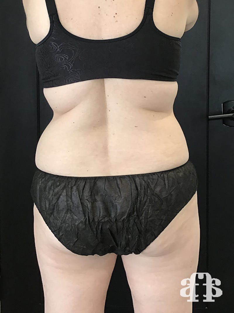 CoolSculpting Before & After Gallery - Patient 52660135 - Image 10