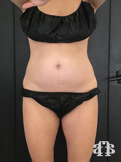 CoolSculpting Gallery - Patient 52660148 - Image 1