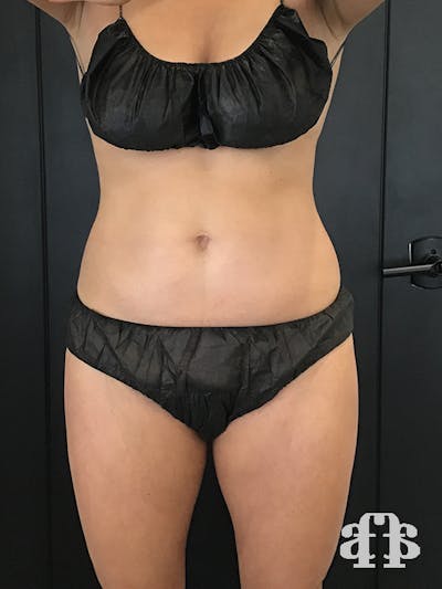 CoolSculpting Before & After Gallery - Patient 52660148 - Image 2