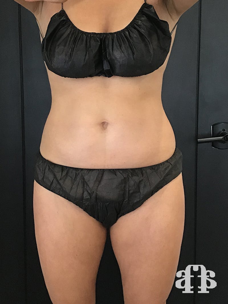 CoolSculpting Before & After Gallery - Patient 52660148 - Image 2