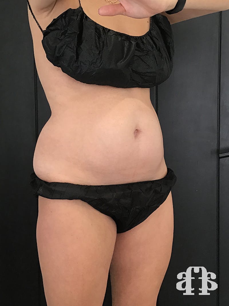 CoolSculpting Before & After Gallery - Patient 52660148 - Image 3