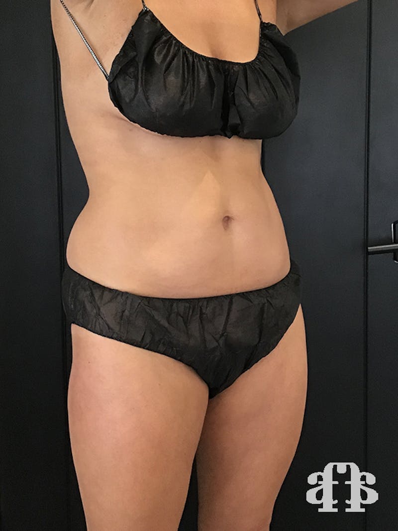 CoolSculpting Before & After Gallery - Patient 52660148 - Image 4