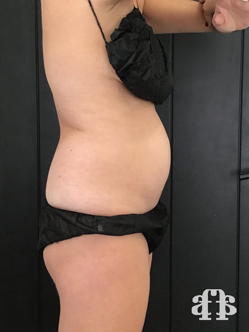 CoolSculpting Before & After Gallery - Patient 52660148 - Image 5