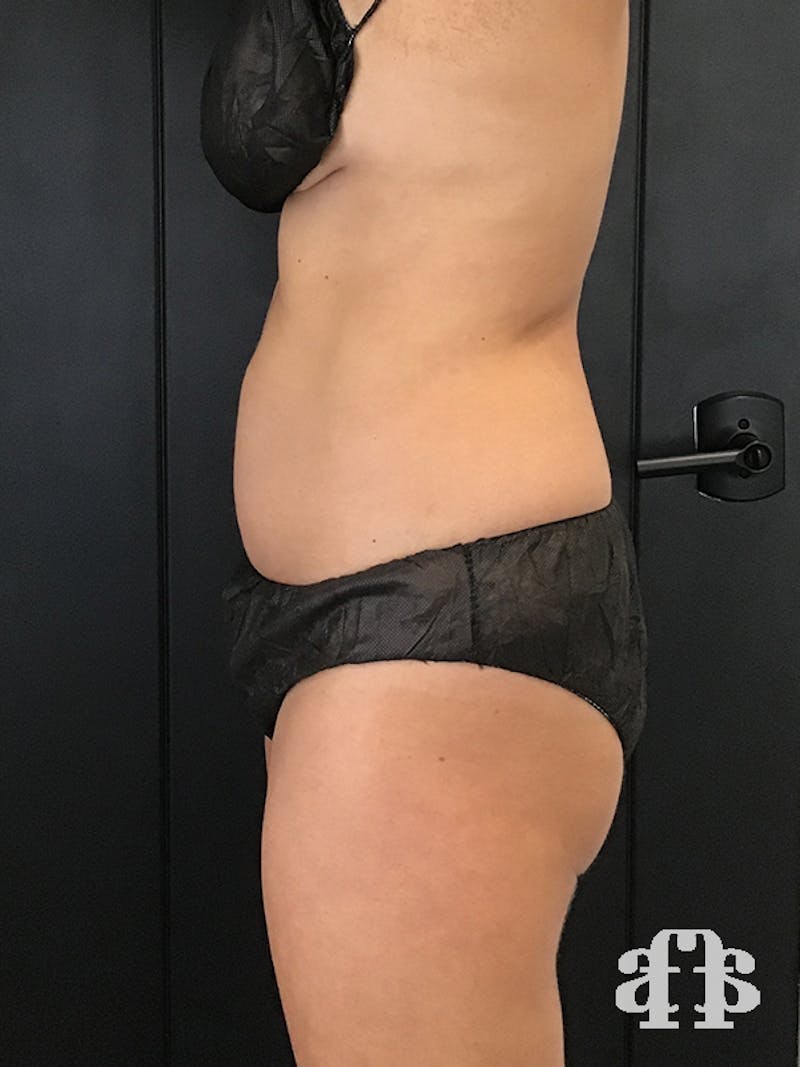 CoolSculpting Before & After Gallery - Patient 52660148 - Image 8