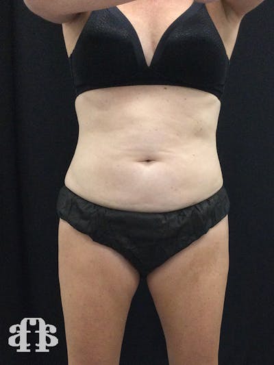CoolSculpting Before & After Gallery - Patient 52660185 - Image 1