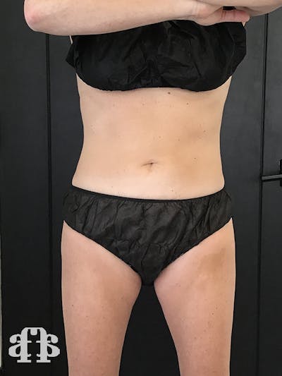 CoolSculpting Before & After Gallery - Patient 52660185 - Image 2