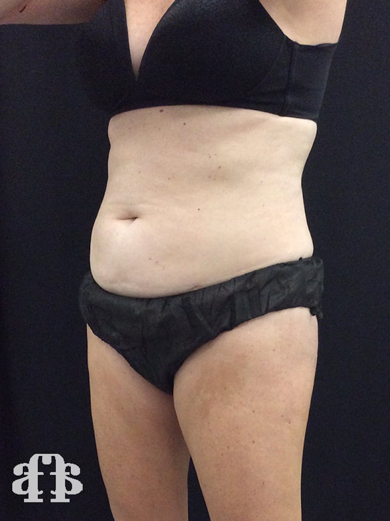 CoolSculpting Before & After Gallery - Patient 52660185 - Image 3