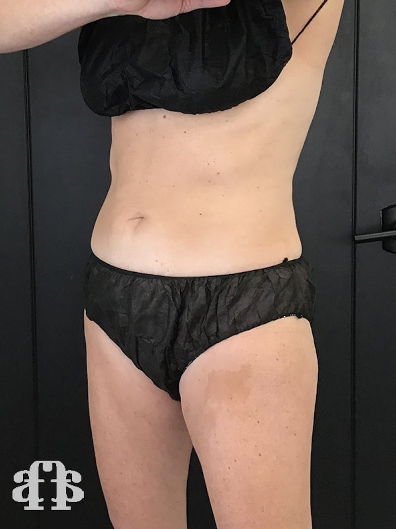 CoolSculpting Before & After Gallery - Patient 52660185 - Image 4