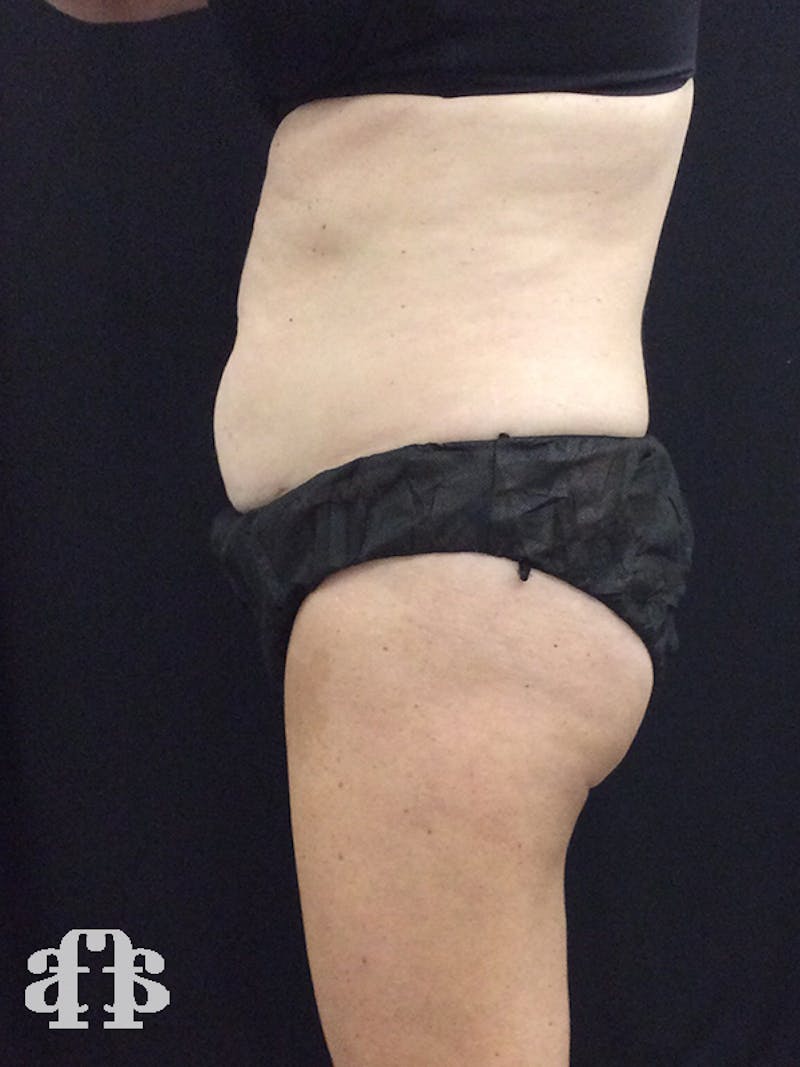 CoolSculpting Before & After Gallery - Patient 52660185 - Image 5