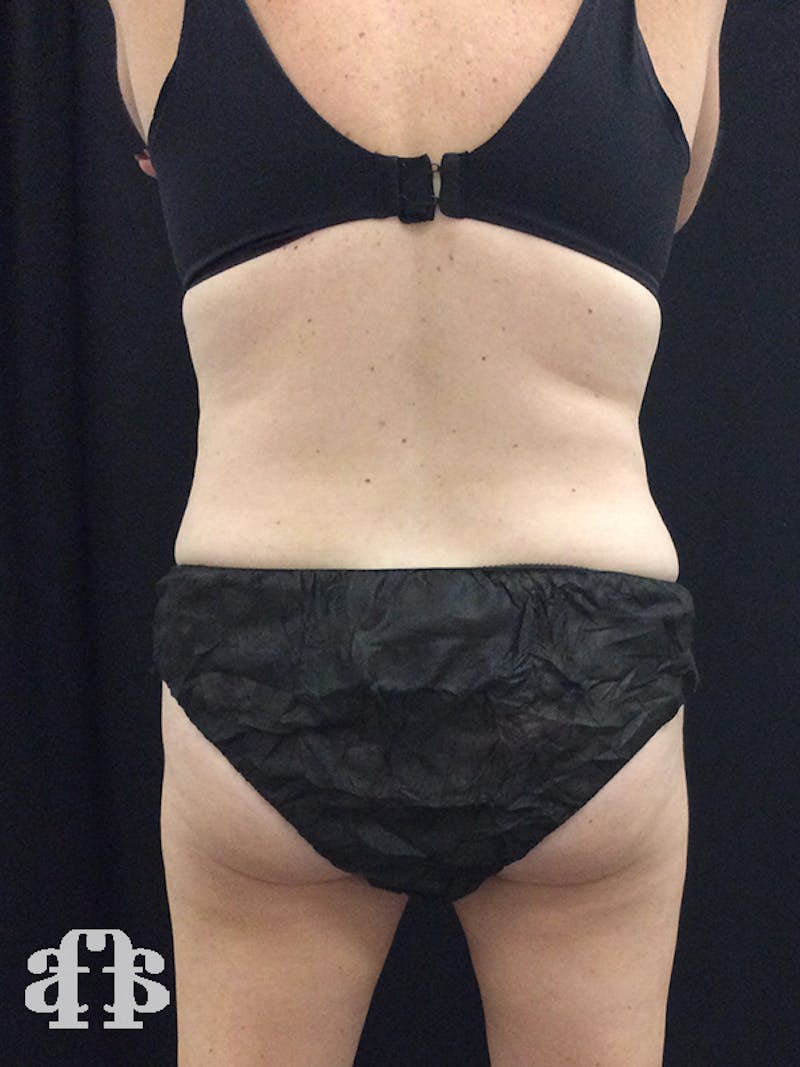 CoolSculpting Before & After Gallery - Patient 52660185 - Image 8