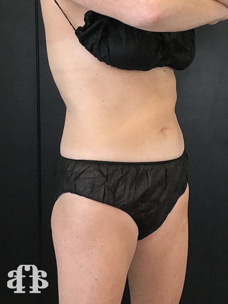 CoolSculpting Before & After Gallery - Patient 52660185 - Image 10