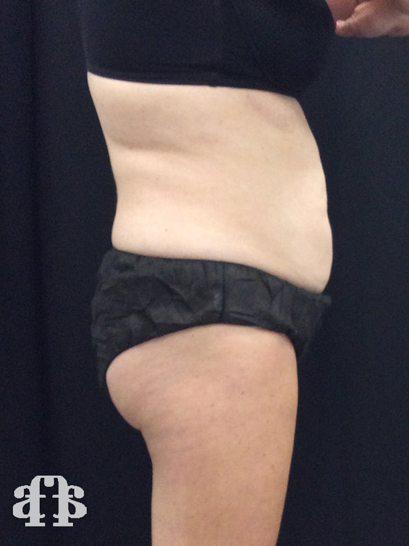 CoolSculpting Before & After Gallery - Patient 52660185 - Image 11