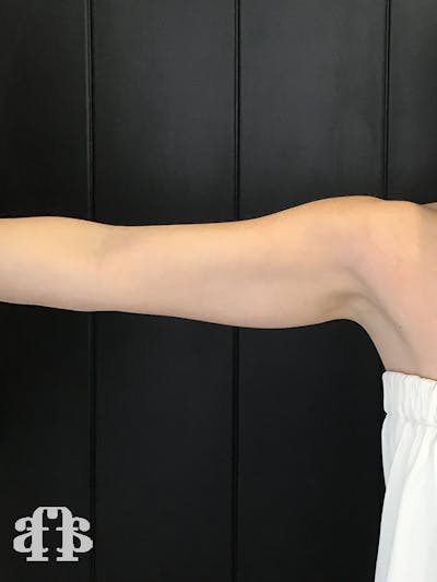 CoolSculpting Before & After Gallery - Patient 52660186 - Image 1