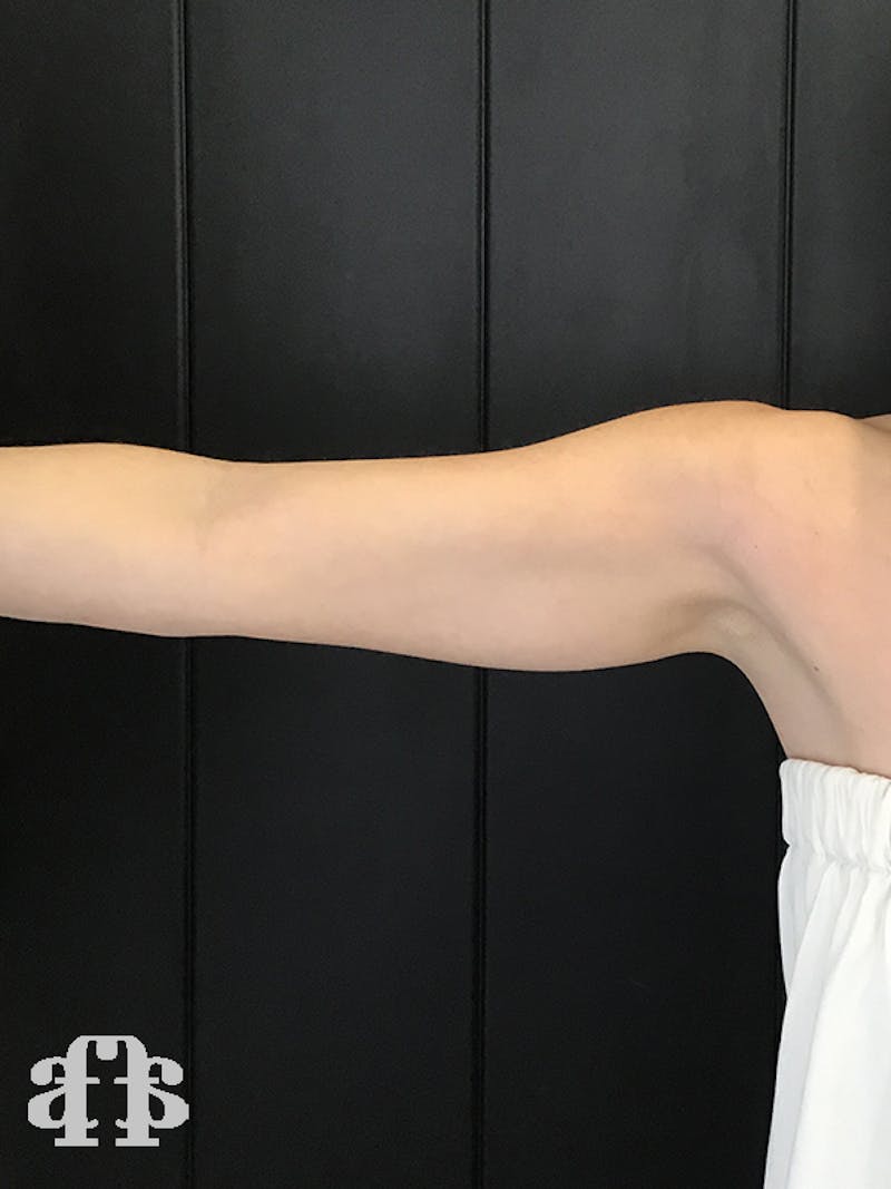 CoolSculpting Before & After Gallery - Patient 52660186 - Image 1
