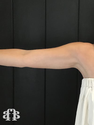 CoolSculpting Before & After Gallery - Patient 52660186 - Image 2