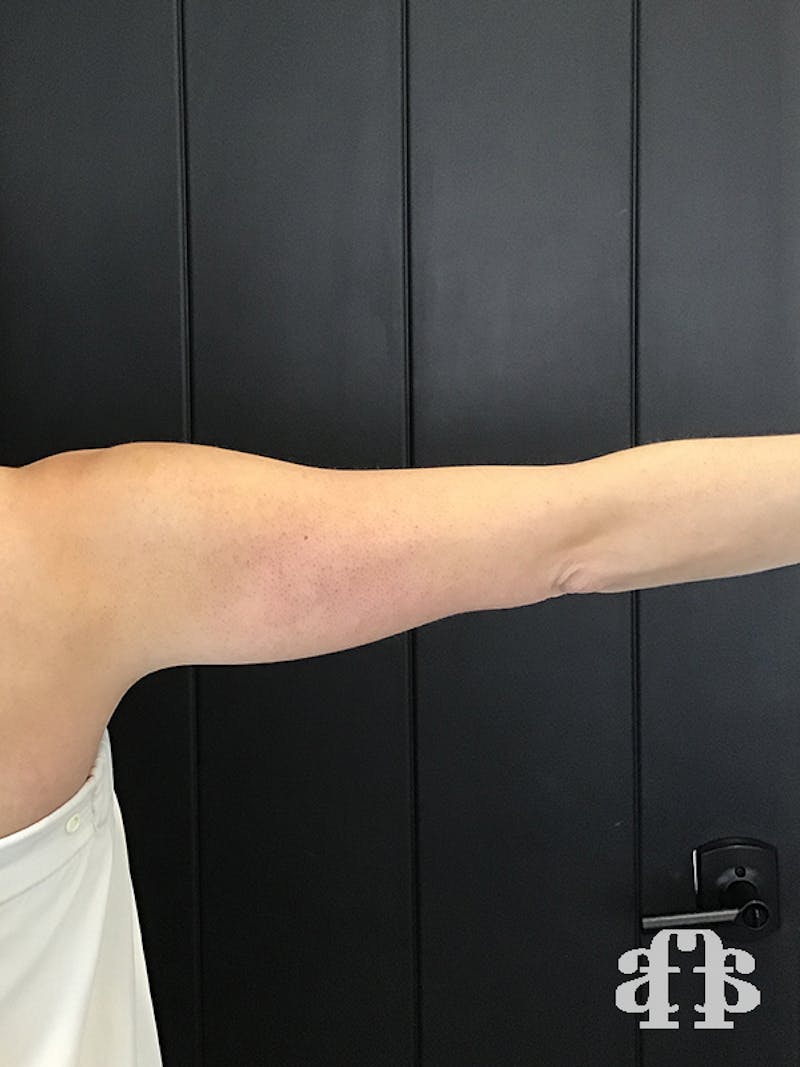 CoolSculpting Before & After Gallery - Patient 52660186 - Image 3