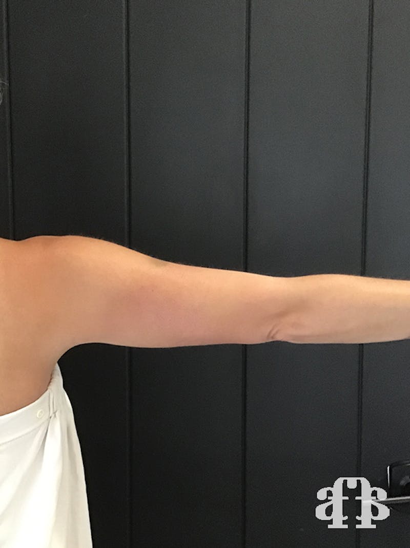 CoolSculpting Before & After Gallery - Patient 52660186 - Image 4