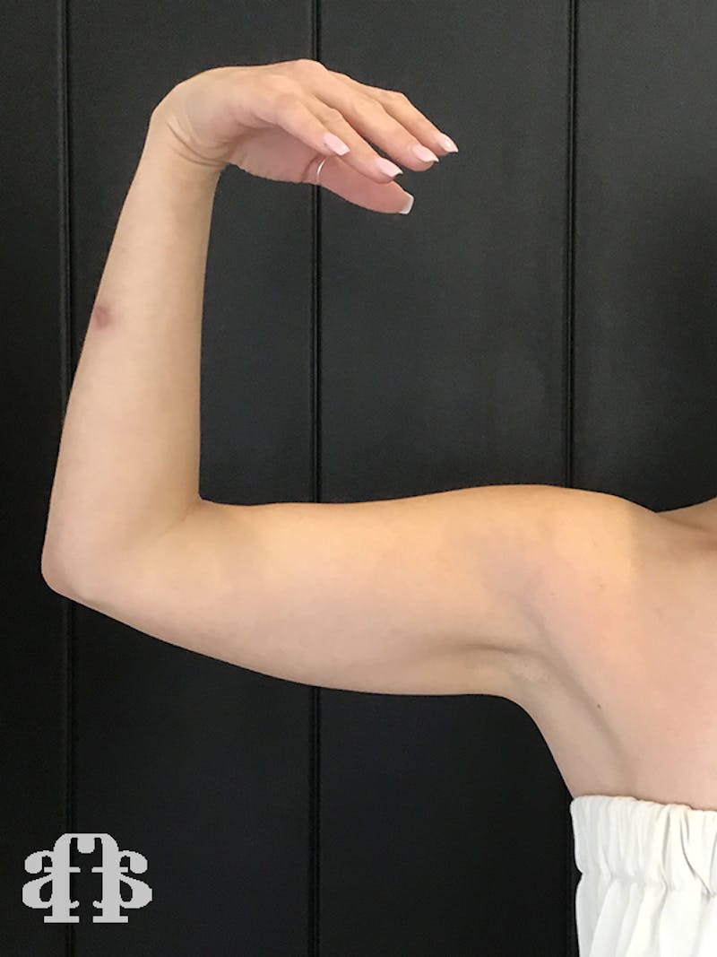 CoolSculpting Before & After Gallery - Patient 52660186 - Image 5