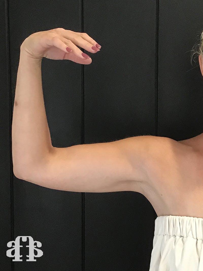 CoolSculpting Before & After Gallery - Patient 52660186 - Image 6