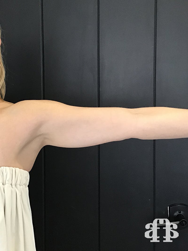 CoolSculpting Before & After Gallery - Patient 52660186 - Image 7