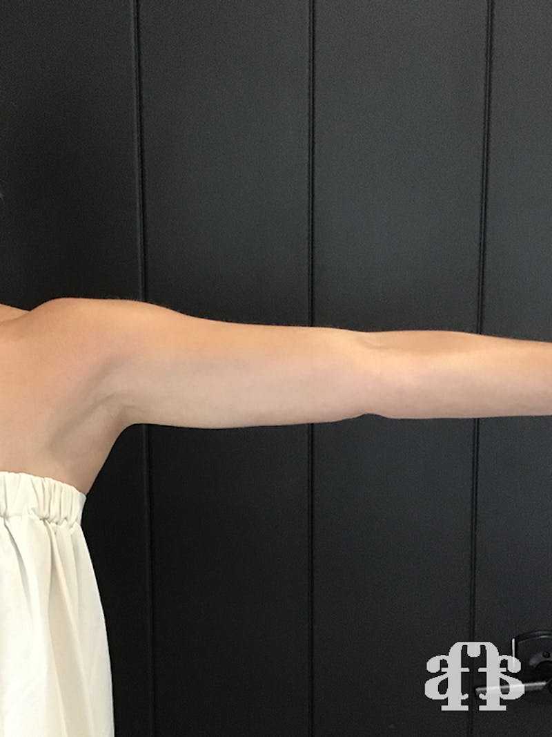 CoolSculpting Before & After Gallery - Patient 52660186 - Image 8