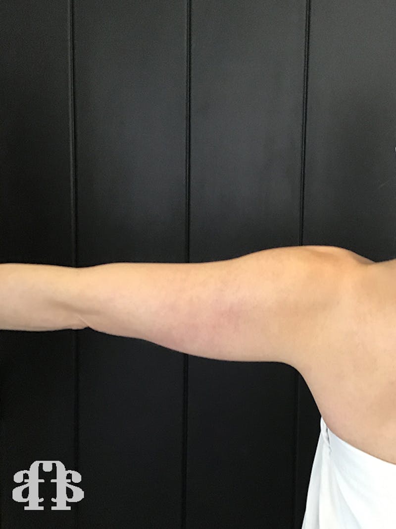 CoolSculpting Before & After Gallery - Patient 52660186 - Image 9