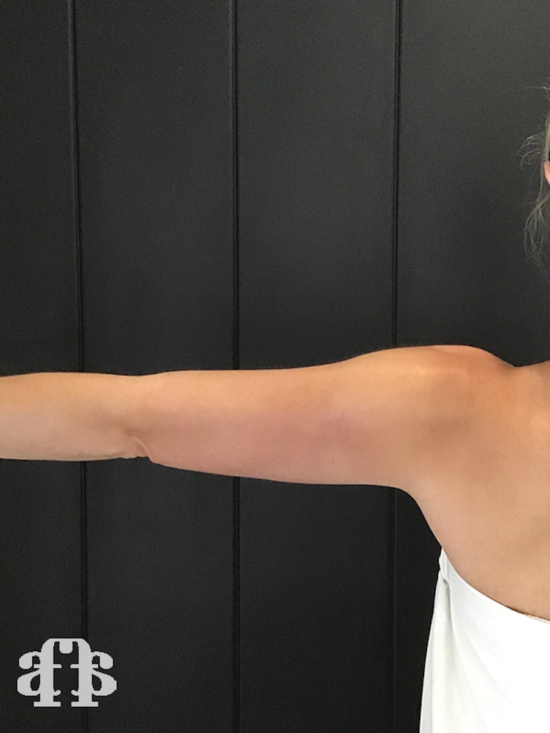 CoolSculpting Before & After Gallery - Patient 52660186 - Image 10