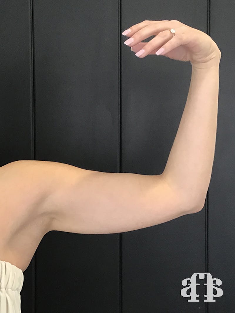 CoolSculpting Before & After Gallery - Patient 52660186 - Image 11