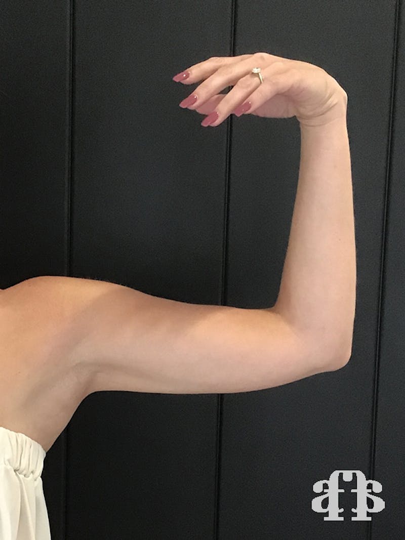 CoolSculpting Before & After Gallery - Patient 52660186 - Image 12