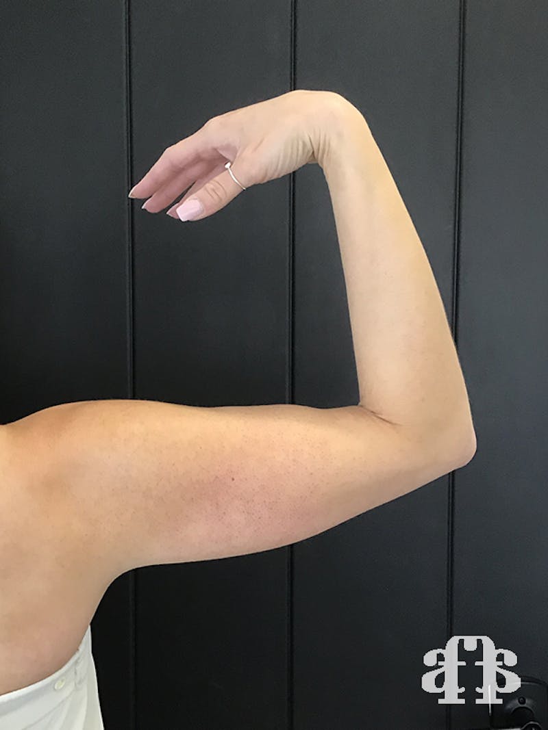 CoolSculpting Before & After Gallery - Patient 52660186 - Image 13