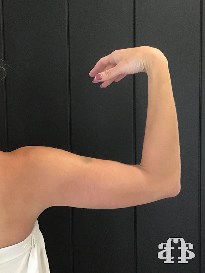 CoolSculpting Before & After Gallery - Patient 52660186 - Image 14