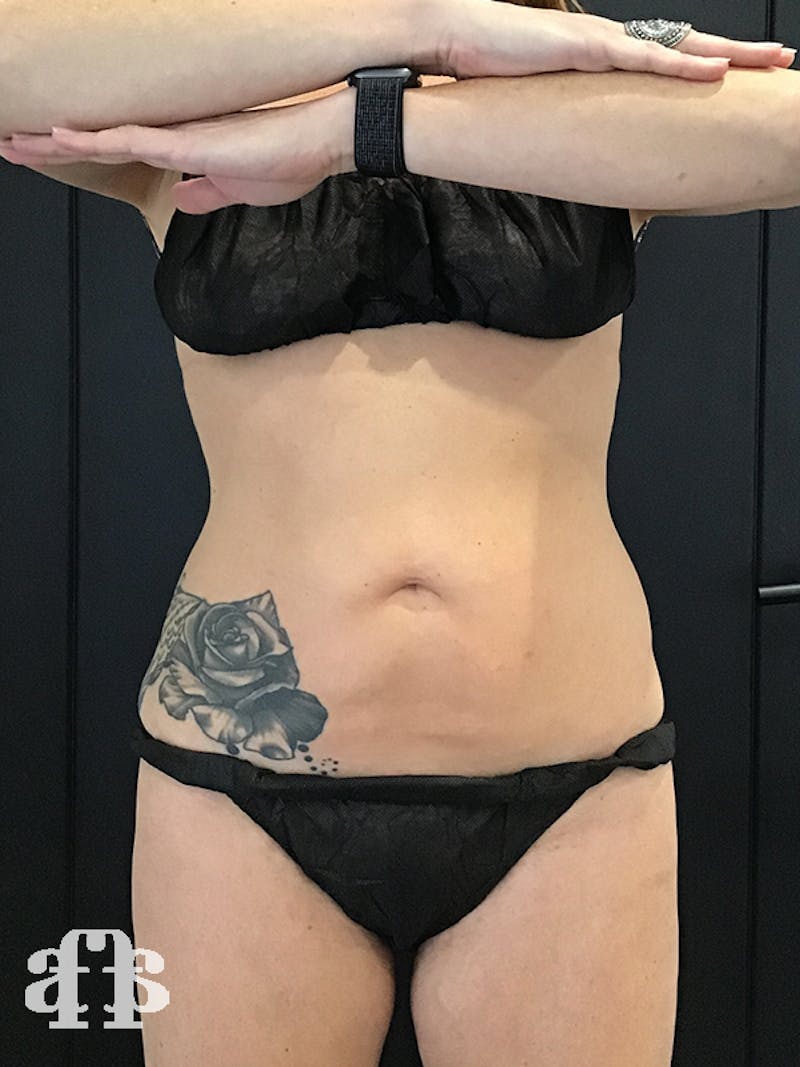 CoolSculpting Before & After Gallery - Patient 52660187 - Image 3