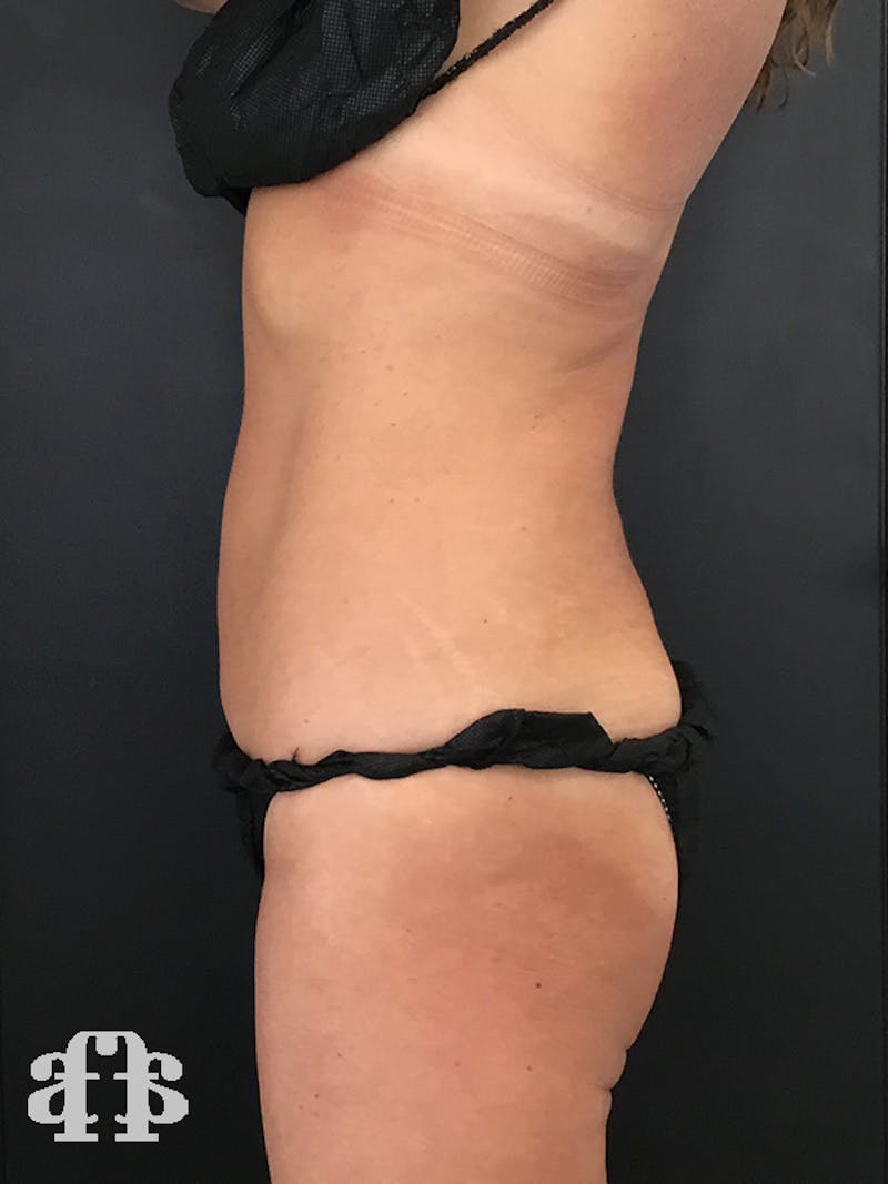 CoolSculpting Before & After Gallery - Patient 52660187 - Image 6