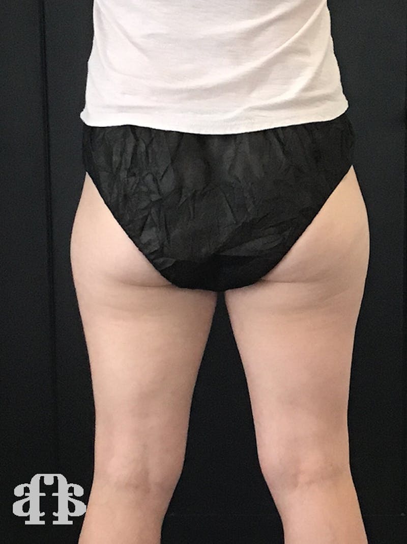 CoolSculpting Before & After Gallery - Patient 52660188 - Image 1