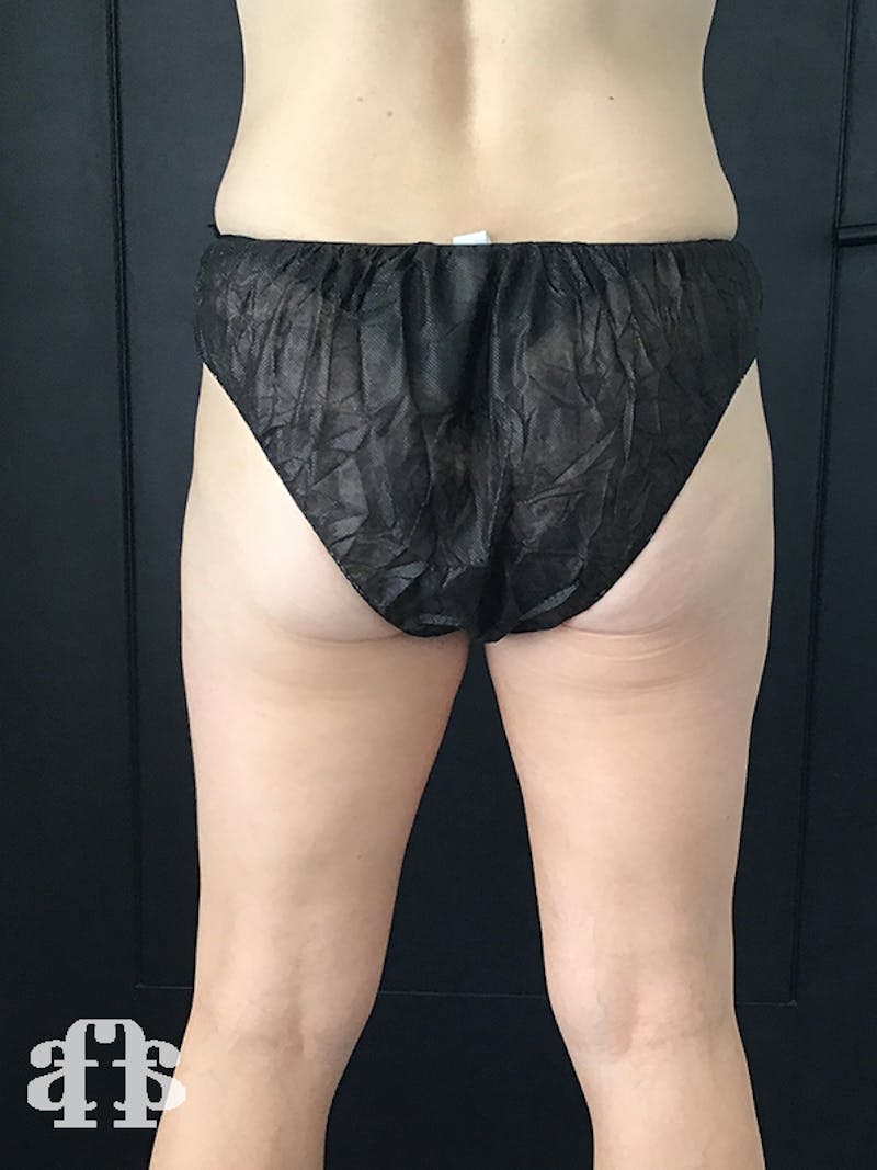 CoolSculpting Before & After Gallery - Patient 52660188 - Image 2