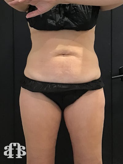 CoolSculpting Before & After Gallery - Patient 52660189 - Image 1